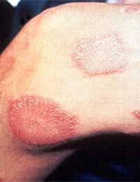 Leprosy Mycobacterium Leprae Leprosy
