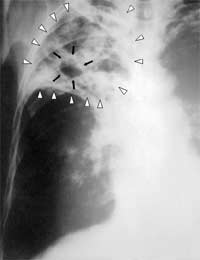 Tuberculosis Tb Consumption Wasting