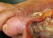 What is Gangrene?