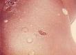 What is Impetigo?