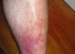 What is Cellulitis?