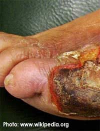 Gangrene Gas Gangrene Ischaemia