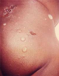 Impetigo Skin Infection Staphylococcus