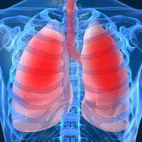 Pneumonia Bacterial Pneumonia