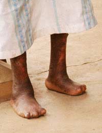 Leprosy Bacterial Infection World Health