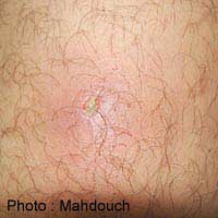 Hot Tub Folliculitis Pseudomonas