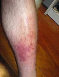 Cellulitis Skin Infection Cellulite